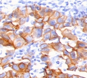 IHC staining of FFPE human breast carcinoma with NRG1 antibody (clone HRGA1-1). HIER: boil tissue sections in pH 9 10mM Tris with 1mM EDTA for 10-20 min and allow to cool before testing.