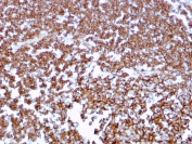 IHC staining of FFPE human tonsil tissue with CD20 antibody (clone MS4A1/3409). HIER: boil tissue sections in pH6, 10mM citrate buffer, for 10-20 min and allow to cool before testing.
