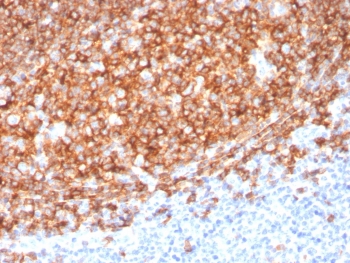 IHC staining of FFPE human tonsil tissue with CD20 antibody (clone MS4A1/3410). HIER: boil tissue sections in pH6, 10mM citrate buffer, for 10-20 min and allow to cool before testing.~