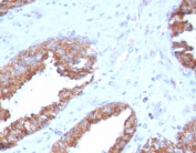 IHC testing of FFPE human prostate carcinoma with FOLH1 antibody (clone FOLH1/2363). Required HIER: boil tissue sections in pH 9 10mM Tris with 1mM EDTA for 10-20 min and allow to cool before testing.