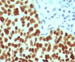 IHC staining of FFPE human cervical carcinoma with recombinant SOX2 antibody (clone SBX2-1R). HIER: boil tissue sections in pH 9 10mM Tris with 1mM EDTA for 10-20 min and allow to cool before testing.~