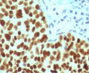 IHC staining of FFPE human cervical carcinoma with recombinant SOX2 antibody (clone SBX2-1R). HIER: boil tissue sections in pH 9 10mM Tris with 1mM EDTA for 10-20 min and allow to cool before testing.