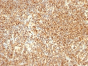 IHC staining of FFPE human lymphoma with CD20 antibody (clone L26). HIER: boil tissue sections in pH 9 10mM Tris with 1mM EDTA for 10-20 min and allow to cool before testing.