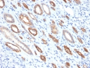 IHC staining of FFPE human renal cell carinoma with Occludin antibody (clone OCLN/2181). HIER: boil tissue sections in pH 9 10mM Tris with 1mM EDTA for 10-20 min and allow to cool before testing.