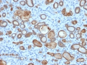 IHC staining of FFPE human thyroid carinoma with Occludin antibody (clone OCLN/2181). HIER: boil tissue sections in pH 9 10mM Tris with 1mM EDTA for 10-20 min and allow to cool before testing.