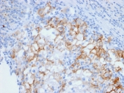 IHC testing of FFPE human renal cell carcinoma and Cadherin 16 antibody. Staining of formalin-fixed tissues requires boiling tissue sections in 10mM Tris with 1mM EDTA, pH 9.0, for 10-20 min followed by cooling at RT for 20 min.