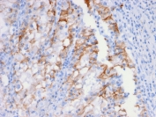 IHC testing of FFPE human renal cell carcinoma and Cadherin 16 antibody. Staining of formalin-fixed tissues requires boiling tissue sections in 10mM Tris with 1mM EDTA, pH 9.0, for 10-20 min followed by cooling at RT for 20 min.