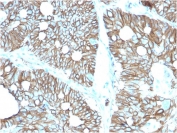 IHC staining of FFPE human colon with Cadherin 17 antibody (clone CDH17/2616). HIER: boil tissue sections in pH 9 10mM Tris with 1mM EDTA for 10-20 min and allow to cool before testing.