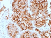 IHC staining of FFPE human lung mesothelioma with Mesothelin antibody (clone SPM143). HIER: boil tissue sections in pH 9 10mM Tris with 1mM EDTA for 10-20 min followed by cooling at RT for 20 min.