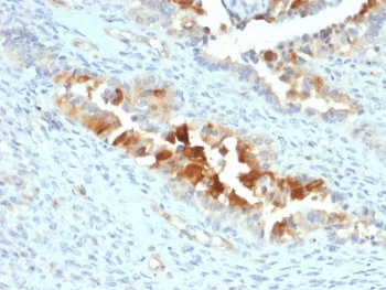 IHC staining of FFPE human endometrial carcinoma with Mesothelin antibody (clone SPM143). HIER: boil tissue sections in pH 9 10mM Tris with 1mM EDTA for 10-20 min followed by cooling at RT for 20 min.~