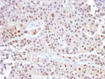 IHC staining of FFPE human urothelial carcinoma with recombinant p21 antibody (clone CIP1/2489R). HIER: boil tissue sections in pH 9 10mM Tris with 1mM EDTA for 10-20 min and allow to cool before testing.~