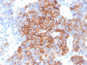 IHC staining of FFPE human bladder carcinoma with Beta Tubulin antibody (TUBB3/3732). HIER: boil tissue sections in pH 9 10mM Tris with 1mM EDTA for 10-20 min and allow to cool before testing.