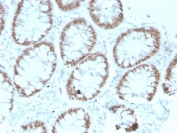 IHC testing of FFPE human colon with recombinant CDX2 antibody (clone rCDX2/1690). HIER: boil tissue sections in 10mM Tris with 1mM EDTA, pH 9, for 10-20 min followed by cooling prior to testing.