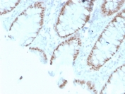 IHC testing of FFPE human colon with recombinant CDX2 antibody (clone rCDX2/1690). HIER: boil tissue sections in 10mM Tris with 1mM EDTA, pH 9, for 10-20 min followed by cooling prior to testing.