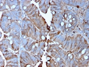 IHC staining of FFPE human colon carcinoma with MerTK  antibody (clone MERTK/3015). HIER: boil tissue sections in pH 9 10mM Tris with 1mM EDTA for 10-20 min and allow to cool before testing.