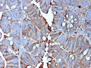 IHC staining of FFPE human colon carcinoma with MerTK antibody (clone MERTK/3015). HIER: boil tissue sections in pH 9 10mM Tris with 1mM EDTA for 10-20 min and allow to cool before testing.