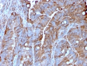 IHC staining of FFPE human colon carcinoma with MerTK  antibody (clone MERTK/3022). HIER: boil tissue sections in pH 9 10mM Tris with 1mM EDTA for 10-20 min and allow to cool before testing.