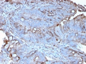 IHC staining of FFPE human colon carcinoma with MerTK  antibody (clone MERTK/3022). HIER: boil tissue sections in pH 9 10mM Tris with 1mM EDTA for 10-20 min and allow to cool before testing.