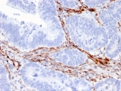 IHC staining of FFPE human colon carcinoma with Nestin antibody (clone NES/2911). HIER: boil tissue sections in pH 9 10mM Tris with 1mM EDTA for 10-20 min and allow to cool before testing.