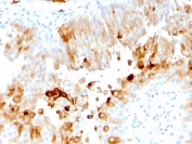 IHC staining of FFPE human urothelial carcinoma with UPK1A antibody (clone UPK1A/2921). HIER: boil tissue sections in pH 9 10mM Tris with 1mM EDTA for 10-20 min and allow to cool before testing.
