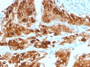 IHC staining of FFPE human urothelial carcinoma with UPK1A antibody (clone UPK1A/2921). HIER: boil tissue sections in pH 9 10mM Tris with 1mM EDTA for 10-20 min and allow to cool before testing.