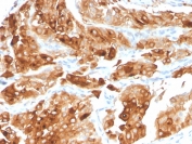 IHC staining of FFPE human urothelial carcinoma with UPK1A antibody (clone UPK1A/2922). HIER: boil tissue sections in pH 9 10mM Tris with 1mM EDTA for 10-20 min and allow to cool before testing.