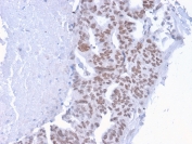 IHC staining of FFPE human breast carcinoma with CHD4 antibody (clone 3F2/4). HIER: boil tissue sections in pH 9 10mM Tris with 1mM EDTA for 10-20 min and allow to cool before testing.