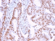 IHC staining of FFPE human breast carcinoma with DMC1 antibody (clone 2H12/4). HIER: boil tissue sections in pH 9 10mM Tris with 1mM EDTA for 10-20 min and allow to cool before testing.