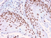 IHC staining of FFPE human cervical carcinoma with DMC1 antibody (clone 2H12/4). HIER: boil tissue sections in pH 9 10mM Tris with 1mM EDTA for 10-20 min and allow to cool before testing.