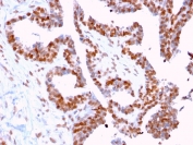 IHC staining of FFPE human prostate carcinoma with DMC1 antibody (clone 2H12/4). HIER: boil tissue sections in pH 9 10mM Tris with 1mM EDTA for 10-20 min and allow to cool before testing.
