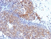 IHC testing of FFPE human melanoma with TOP1MT antibody (clone TOP1MT/568). HIER: boil tissue sections in pH 9 10mM Tris with 1mM EDTA for 10-20 min followed by cooling at RT for 20 min.