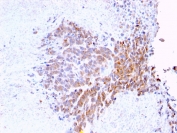 IHC testing of FFPE human melanoma with TOP1MT antibody (clone TOP1MT/568). HIER: boil tissue sections in pH 9 10mM Tris with 1mM EDTA for 10-20 min followed by cooling at RT for 20 min.