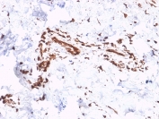 IHC staining of FFPE human skin with Collagen VII antibody (clone LH7.2). HIER: boil tissue sections in pH 9 10mM Tris with 1mM EDTA for 10-20 min and allow to cool before testing.