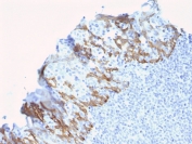 IHC staining of FFPE human breast carcinoma with ZNF690 antibody (clone ZSCAN29/2610). HIER: boil tissue sections in pH 9 10mM Tris with 1mM EDTA for 10-20 min and allow to cool before testing.