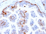 IHC staining of FFPE human prostate with Cystatin A antibody (clone CSTA/2882). HIER: boil tissue sections in pH 9 10mM Tris with 1mM EDTA for 10-20 min and allow to cool before testing.