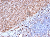 IHC staining of FFPE human liver with Cathepsin D antibody (clone CTSD/3082). HIER: boil tissue sections in pH 9 10mM Tris with 1mM EDTA for 10-20 min and allow to cool before testing.