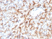 IHC staining of FFPE human liver with Cathepsin D antibody (clone CTSD/3082). HIER: boil tissue sections in pH 9 10mM Tris with 1mM EDTA for 10-20 min and allow to cool before testing.