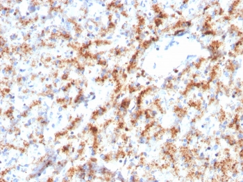 IHC staining of FFPE human liver with Cathepsin D antibody (clone CTSD/3082). HIER: boil tissue sections in pH 9 10mM Tris with 1mM EDTA for 10-20 min and allow to cool before testing.