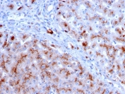 IHC staining of FFPE human liver with Cathepsin D antibody (clone CTSD/3083). HIER: boil tissue sections in pH 9 10mM Tris with 1mM EDTA for 10-20 min and allow to cool before testing.