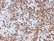IHC staining of FFPE human liver with Cathepsin K antibody (clone CTSK/2792). HIER: boil tissue sections in pH 9 10mM Tris with 1mM EDTA for 10-20 min and allow to cool before testing.