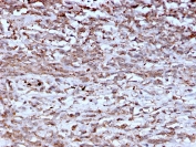 IHC staining of FFPE human hepatocellular carcinoma with Cathepsin K antibody (clone CTSK/2793). HIER: boil tissue sections in pH 9 10mM Tris with 1mM EDTA for 10-20 min and allow to cool before testing.