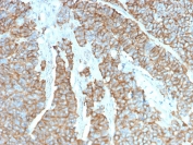 IHC staining of FFPE human neuroendocrine tumor with Drebrin 1 antibody (clone DBN1/3393). HIER: boil tissue sections in pH 9 10mM Tris with 1mM EDTA for 10-20 min followed by cooling at RT for 20 min.