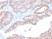 IHC staining of FFPE human prostate carcinoma with AKR1C2 antibody (clone CPTC-AKR1C2-1). HIER: boil tissue sections in pH 9 10mM Tris with 1mM EDTA for 10-20 min and allow to cool before testing.