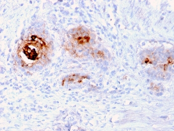 IHC staining of human breast carcinoma with recombinant TAG-72 antibody (clone rB72.3). HIER: boil tissue sections in pH 9 10mM Tris with 1mM EDTA for 10-20 min and allow to cool before testing.~