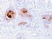 IHC staining of human breast carcinoma with recombinant TAG-72 antibody (clone rB72.3). HIER: boil tissue sections in pH 9 10mM Tris with 1mM EDTA for 10-20 min and allow to cool before testing.