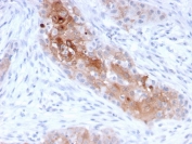 IHC testing of FFPE human bladder carcinoma with Desmoglein 1 antibody (clone 32-2B). HIER: boil tissue sections in pH 9 10mM Tris with 1mM EDTA for 10-20 min.