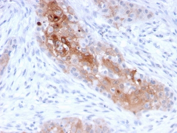 IHC testing of FFPE human bladder carcinoma with Desmoglein 1 antibody (clone 32-2B). HIER: boil tissue sections in pH 9 10mM Tris with 1mM EDTA for 10-20 min.