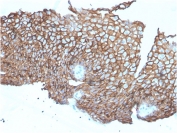 IHC staining of FFPE human esophageal carcinoma with Desmoglein 3 antibody (clone DSG3/2840). HIER: boil tissue sections in pH 9 10mM Tris with 1mM EDTA for 10-20 min and allow to cool before testing.