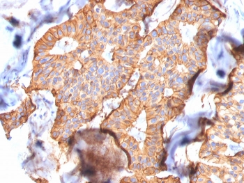 IHC staining of FFPE human breast carcinoma with HER2 antibody (clone SPM172). HIER: boil tissue sections in pH 9 10mM Tris with 1mM EDTA for 10-20 min and allow to cool before testing.~