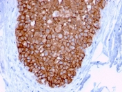 IHC staining of FFPE human breast carcinoma with HER2 antibody (clone ERBB2/3078). HIER: boil tissue sections in pH 9 10mM Tris with 1mM EDTA for 10-20 min and allow to cool before testing.